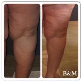 bioslimming-benen